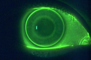 Formstabile Kontaktlinsen bei Optiker Linz Hochwimmer